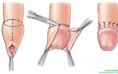 cắt bao quy đầu 152 xã đàn