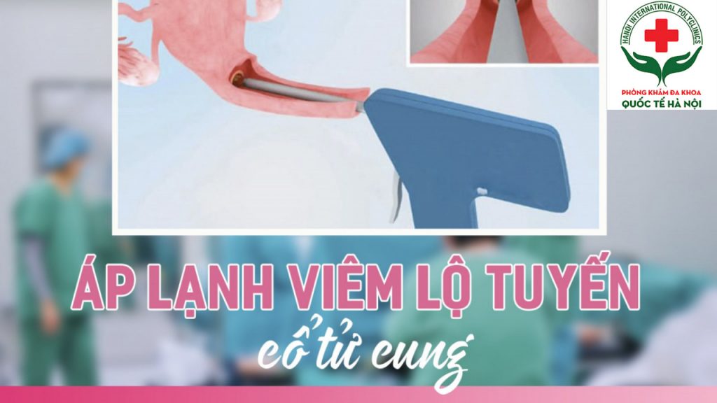Áp lạnh cổ tử cung