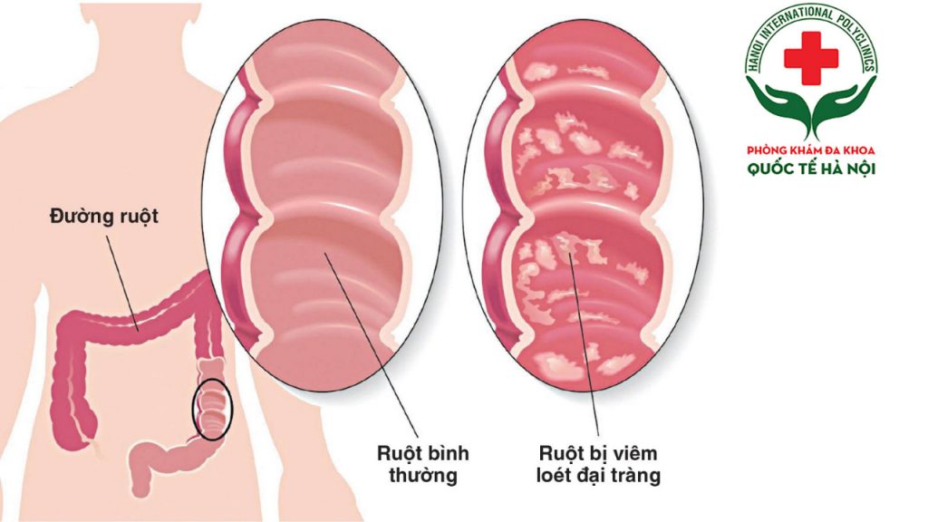 Đau bụng dưới do các bệnh lý đường tiêu hóa