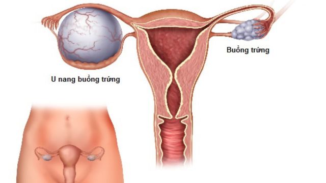 u nang buồng trứng