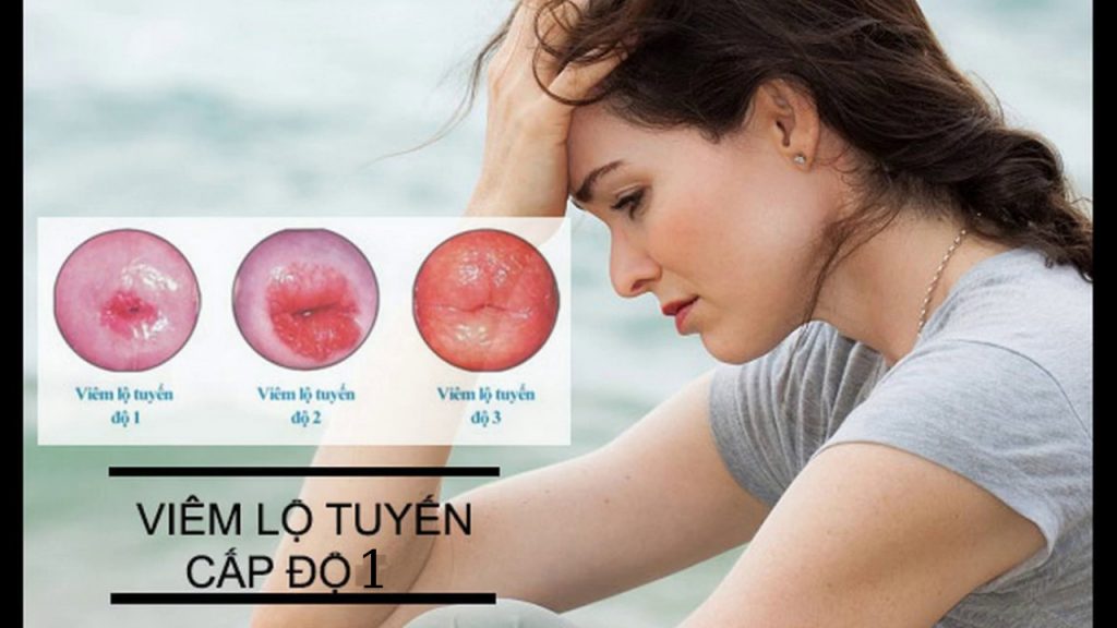 viêm lộ tuyến cổ tử cung cấp độ 1