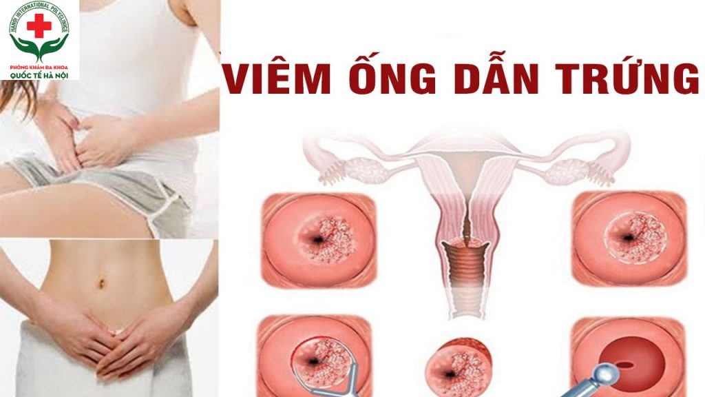 viêm ống dẫn trứng
