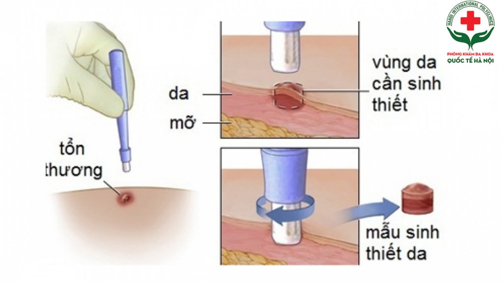 xét nghiệm sinh thiết bao nhiều tiền