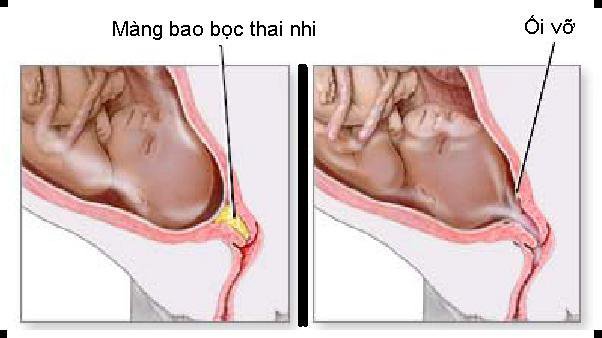 Ối vỡ non