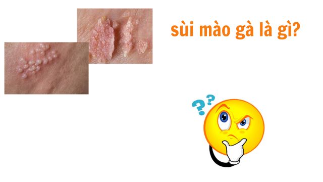 sùi mào gà là gì?