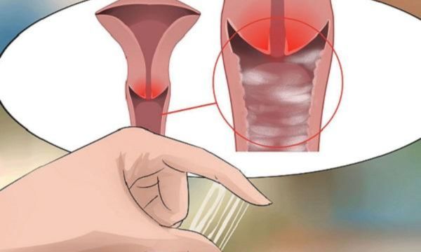 chữa viêm phụ khoa