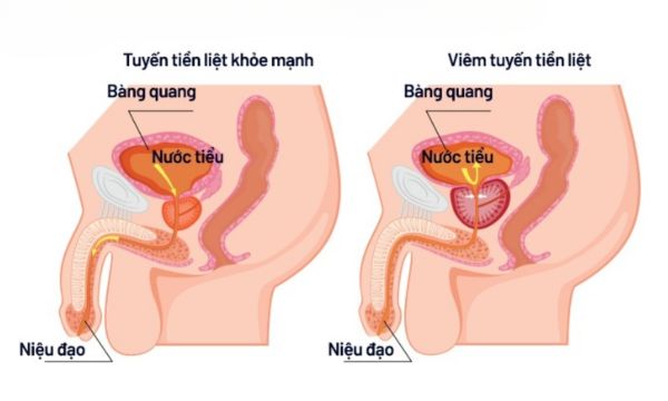 viêm tuyến tiền liệt