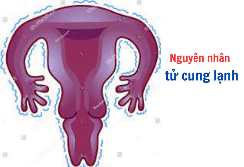 Nguyên nhân nữ giới mắc tử cung lạnh